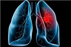 Bệnh ung thư phổi có di truyền không?