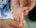 Cách chữa chứng ra mồ hôi tay, chân ở trẻ mẹ nên biết
