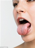 Chẩn đoán bệnh qua sự thay đổi của lưỡi