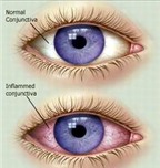 Dấu hiệu của bệnh đau mắt đỏ qua 3 giai đoạn