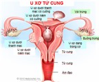 Dấu hiệu, nguyên nhân và cách phòng ngừa bệnh u xơ tử cung
