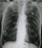 Điện tâm đồ chẩn đoán bệnh phổi tắc nghẽn mãn tinh (COPD)