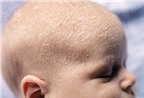 Hiện tượng 'cứt trâu' trên đầu trẻ và cách trị dứt điểm
