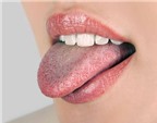 Lưỡi mọc tua dài 1 hoặc 2cm, dưới họng lại có những nốt đỏ có phải mắc bệnh sùi mào gà?