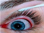 Mắt  | Đau mắt đỏ