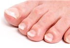 Ngón chân bị sưng đau khi khi cắt móng, có cách nào điều trị?
