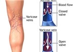 Nguyên nhân và dấu hiệu của bệnh suy giãn tĩnh mạch chân