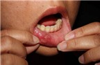 Nhiệt miệng có thể là dấu hiệu của ung thư lưỡi