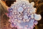 Những điều cần biết về bệnh ung thư tuyến tụy