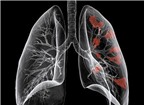Những điều không nên bỏ qua về ung thư phổi