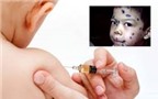 Những trường hợp nào không nên tiêm vắc-xin phòng bệnh thủy đậu?