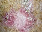 Phân biệt nốt ruồi với các vết ung thư da