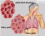 Phòng ngừa các bệnh về đường hô hấp ở người cao tuổi