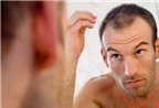 Phương pháp cấy tóc có hiệu quả không?