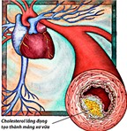 Rối loạn mỡ máu làm tăng nguy cơ các bệnh tim mạch