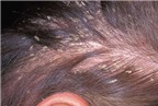 Rụng tóc và cách điều trị