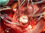Tim mạch    Hở van động mạch chủ do thấp