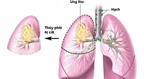 Ung thư phổi có thể nằm ẩn trong cơ thể hơn 20 năm
