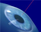 6 thắc mắc hay gặp về mổ lasik chữa cận thị