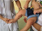 Cách phòng bệnh tay chân miệng ở trẻ