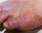 Những bệnh da và niêm mạc do nấm