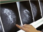 Phụ nữ độc thân dễ có nguy cơ mắc ung thư vú