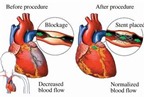 Mũi nhọn điều trị các bệnh lý tim mạch