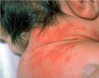 10 loại bệnh về da thường gặp