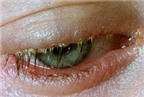 Viêm nhiễm bờ mi mắt, điều trị thế nào?