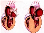 Phương pháp màu nhiệm xử trí bệnh cơ tim phì đại