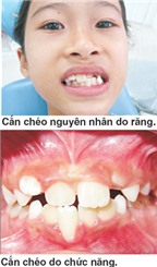 Điều trị cắn chéo răng trước ở trẻ em