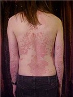 Lupus ban đỏ - “căn bệnh lạ”?