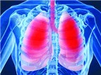 Viêm phổi và cách phòng ngừa