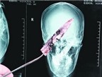 Chữa bệnh hôi miệng lại phát hiện dao trong não