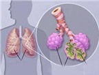 Viêm phổi do phế cầu ở trẻ em: Phòng ngừa thế nào?