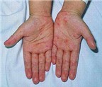 Làm sao phân biệt trẻ sốt do tay chân miệng hay do sốt xuất huyết?