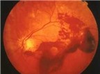 Mắt nhìn thấy các hạt li ti là bệnh gì?
