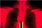 Các giai đoạn của ung thư phổi
