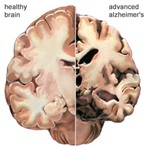 Chụp não giúp chẩn đoán sớm bệnh Alzheimer