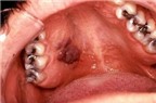 Biểu hiện của ung thư vòm họng