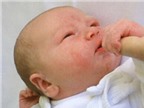 Trị viêm da cơ địa ở trẻ sơ sinh