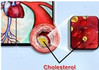 Mức độ cholesterol có lợi cho sức khỏe