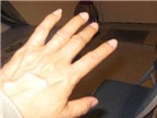 Bàn tay bị nổi gân xanh thì dùng thuốc gì để điều trị?