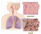 Phòng tránh đợt cấp bệnh phổi tắc nghẽn mạn tính