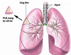 Phương pháp mới phát hiện sớm ung thư phổi