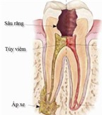 Phục hồi thân răng sau điều trị