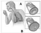 Phù mạch đường hô hấp trên do thuốc và cách đối phó