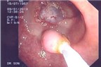 Cắt thành công khối u dạ dày qua đường miệng