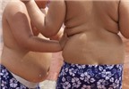 Trẻ béo phì có nguy cơ mắc chứng đa xơ cứng