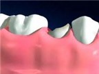 Có cách nào phục hồi răng vỡ không AloBacsi?